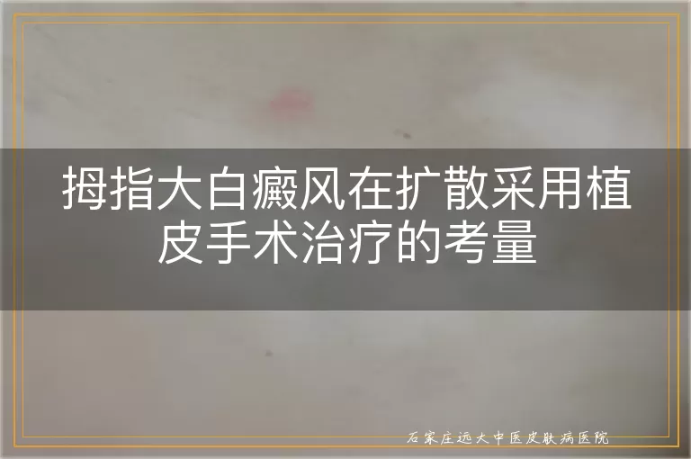 拇指大白癜风在扩散采用植皮手术治疗的考量