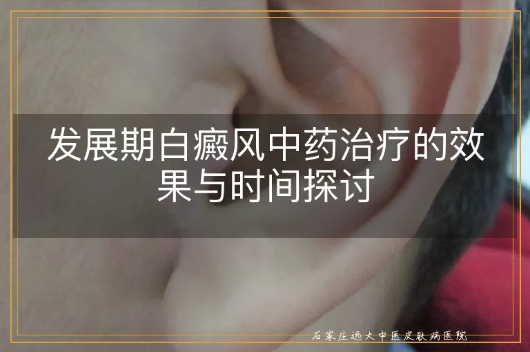 发展期白癜风中药治疗的效果与时间探讨