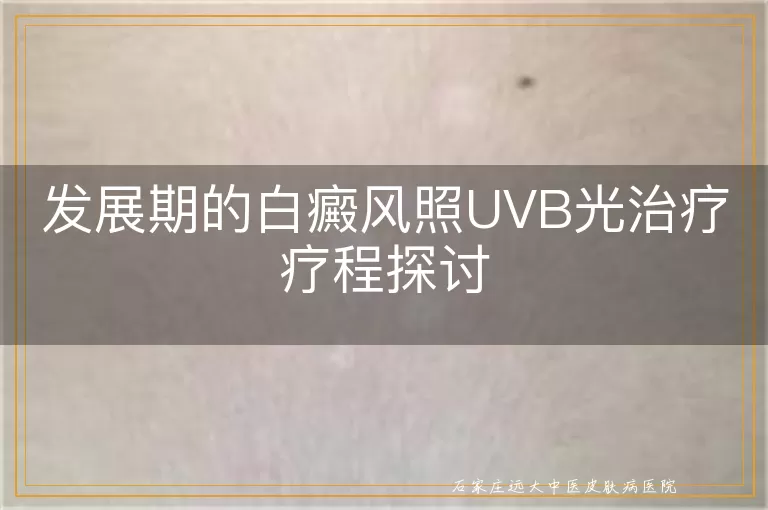 发展期的白癜风照UVB光治疗疗程探讨