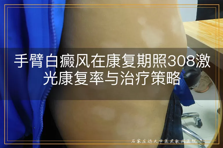 手臂白癜风在康复期照308激光康复率与治疗策略