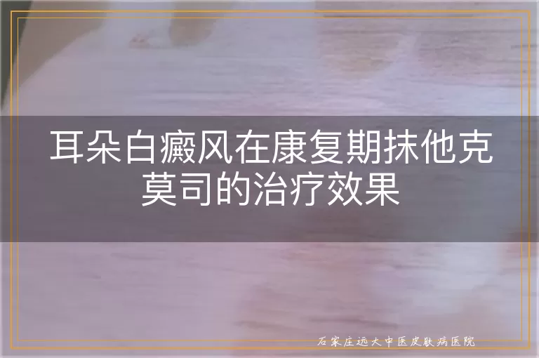 耳朵白癜风在康复期抹他克莫司的治疗效果