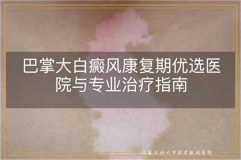 巴掌大白癜风康复期优选医院与专业治疗指南