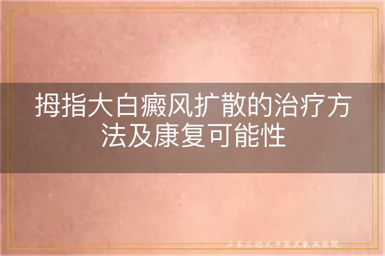 拇指大白癜风扩散的治疗方法及康复可能性
