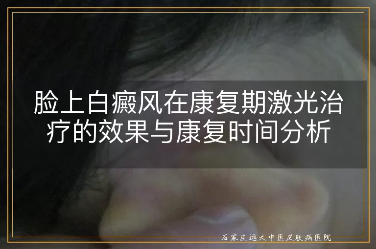 脸上白癜风在康复期激光治疗的效果与康复时间分析