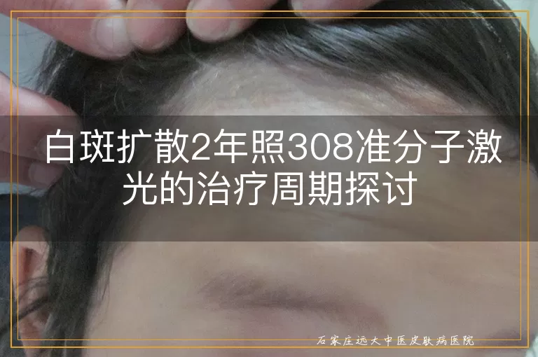 白斑扩散2年照308准分子激光的治疗周期探讨