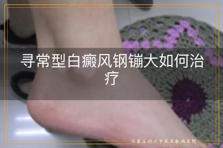 寻常型白癜风钢镚大如何治疗