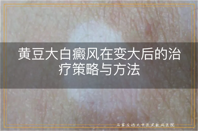 黄豆大白癜风在变大后的治疗策略与方法