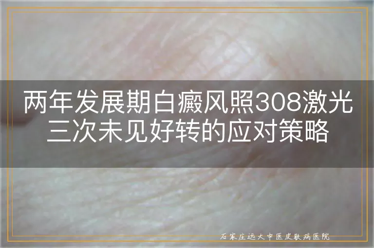 两年发展期白癜风照308激光三次未见好转的应对策略