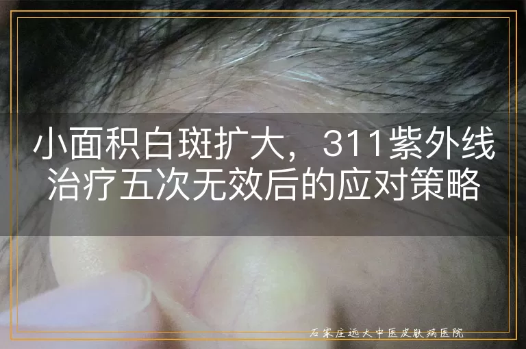 小面积白斑扩大，311紫外线治疗五次无效后的应对策略