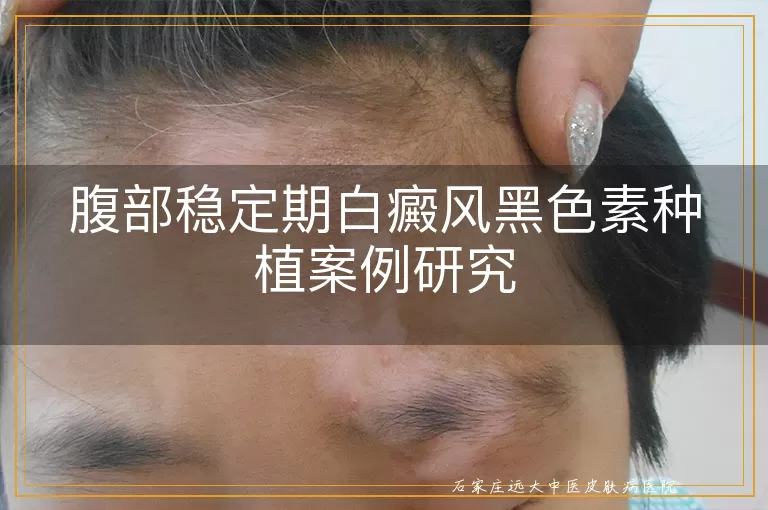 腹部稳定期白癜风黑色素种植案例研究