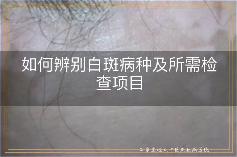 如何辨别白斑病种及所需检查项目