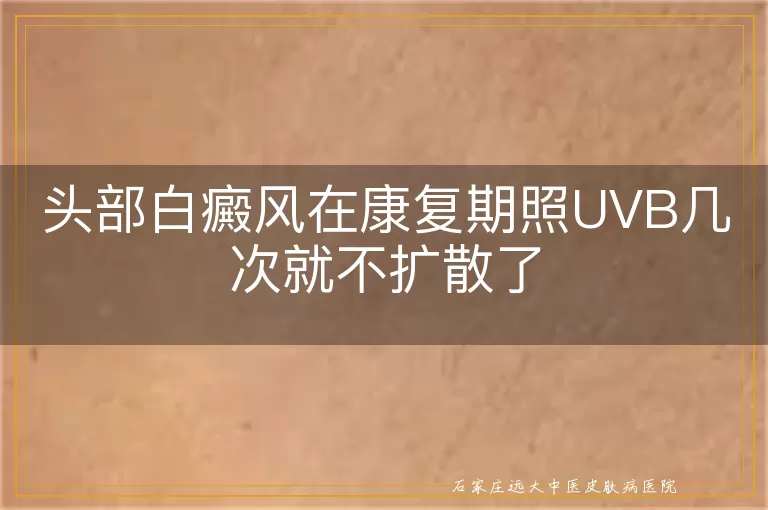 头部白癜风在康复期照UVB几次就不扩散了
