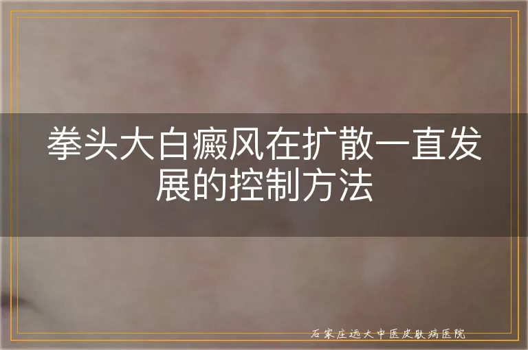 拳头大白癜风在扩散一直发展的控制方法
