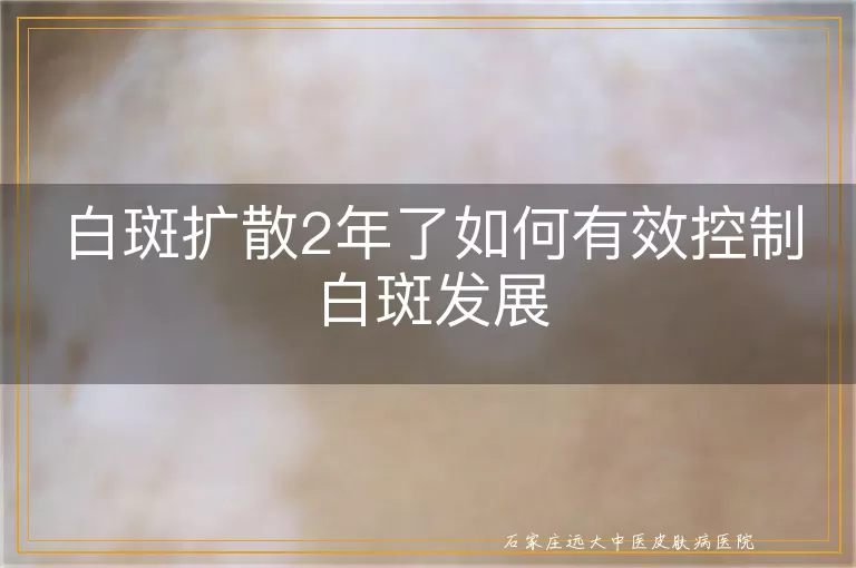 白斑扩散2年了如何有效控制白斑发展