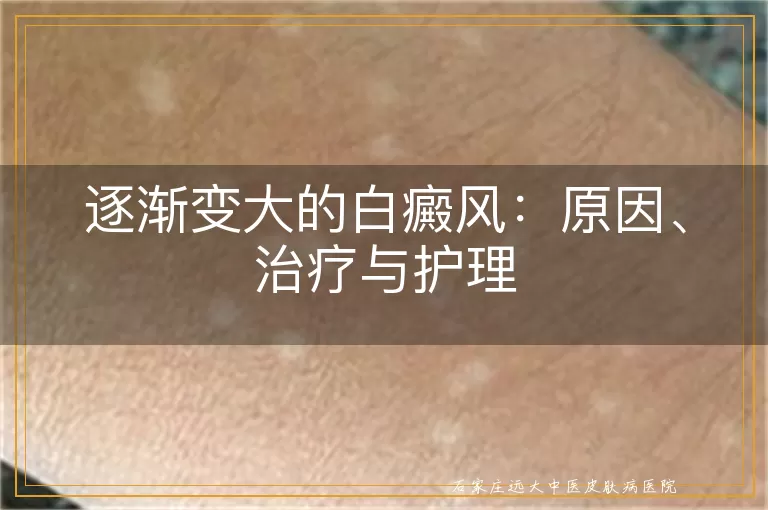 逐渐变大的白癜风:原因、治疗与护理