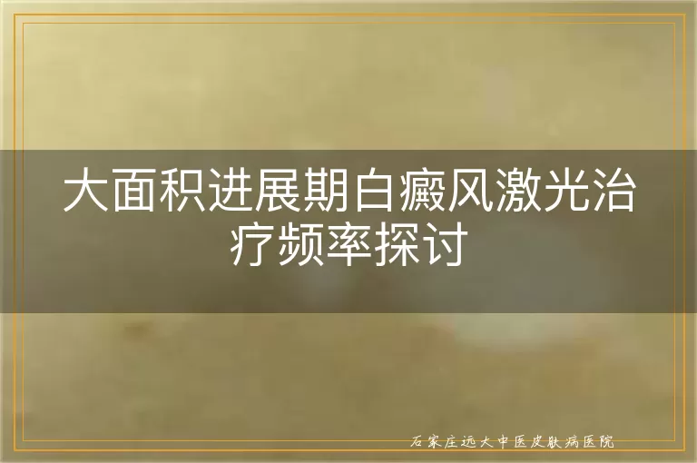 大面积进展期白癜风激光治疗频率探讨