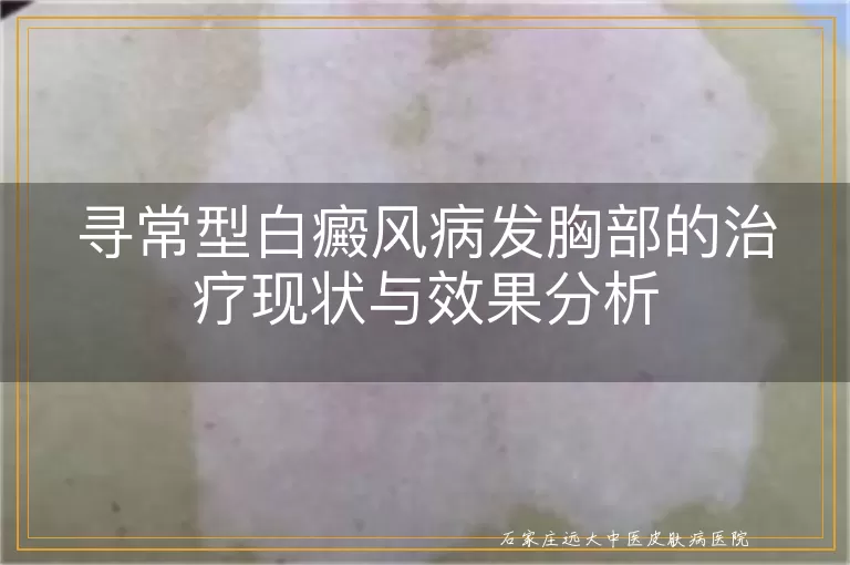 寻常型白癜风病发胸部的治疗现状与效果分析