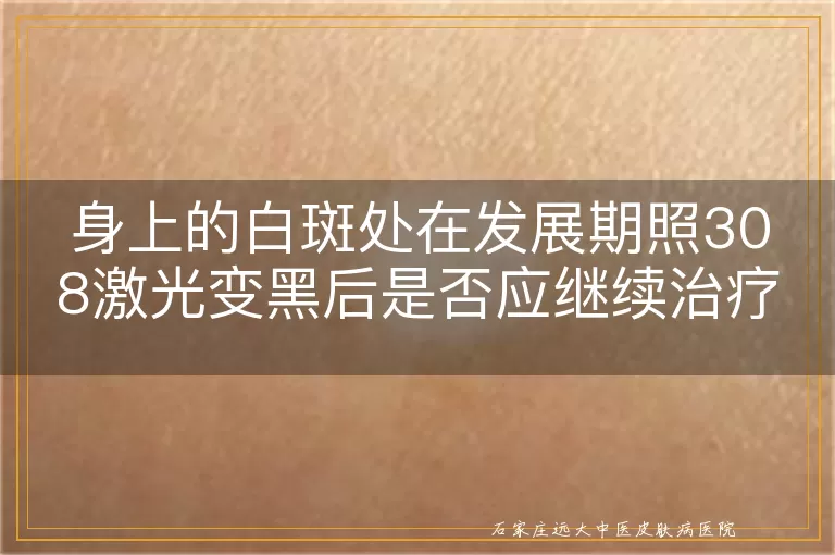 身上的白斑处在发展期照308激光变黑后是否应继续治疗