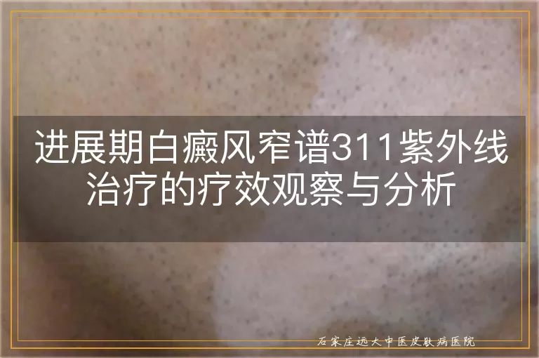 进展期白癜风窄谱311紫外线治疗的疗效观察与分析
