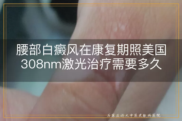 腰部白癜风在康复期照美国308nm激光治疗需要多久