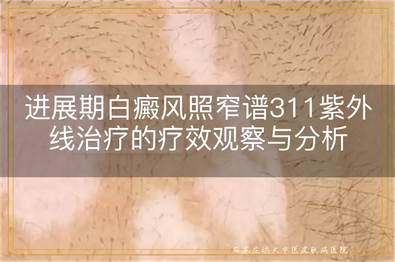 进展期白癜风照窄谱311紫外线治疗的疗效观察与分析