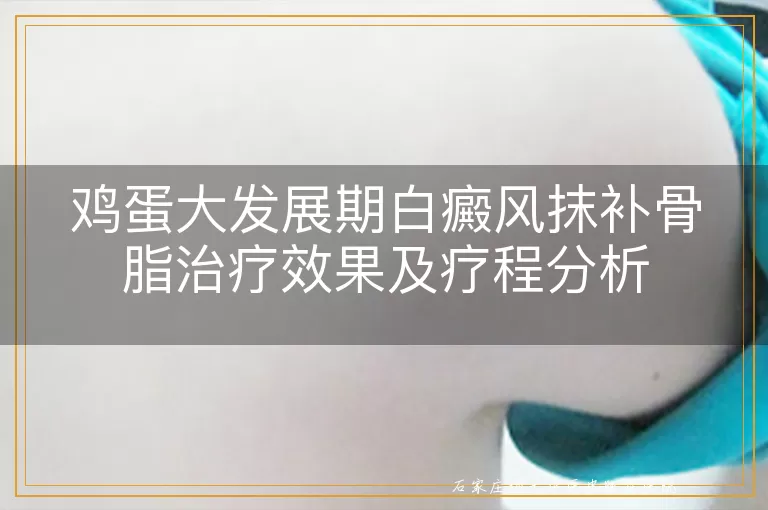 鸡蛋大发展期白癜风抹补骨脂治疗效果及疗程分析