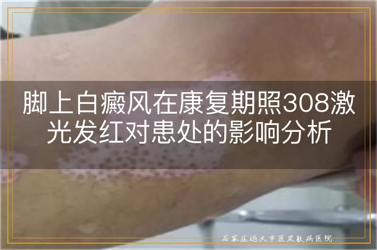 脚上白癜风在康复期照308激光发红对患处的影响分析