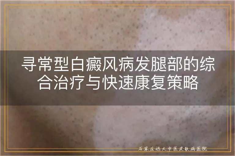 寻常型白癜风病发腿部的综合治疗与快速康复策略