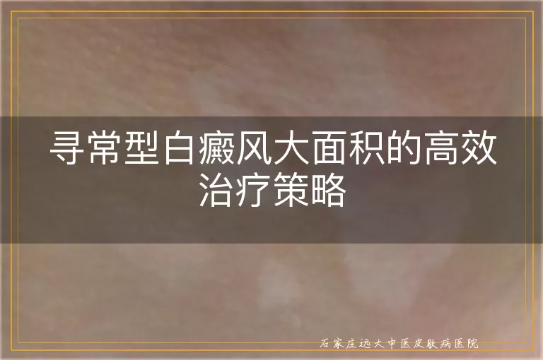 寻常型白癜风大面积的高效治疗策略