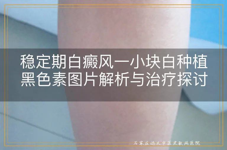 稳定期白癜风一小块白种植黑色素图片解析与治疗探讨