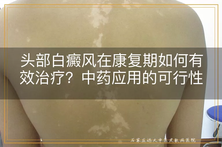 头部白癜风在康复期如何有效治疗?中药应用的可行性探讨