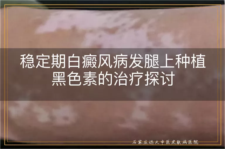 稳定期白癜风病发腿上种植黑色素的治疗探讨