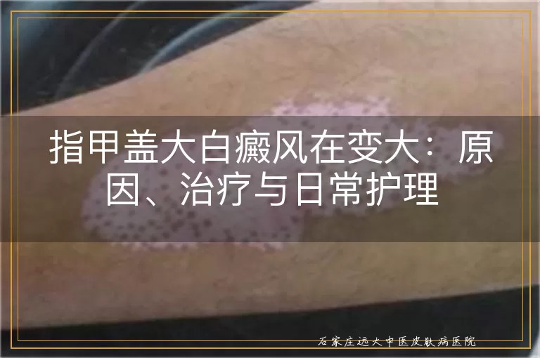 指甲盖大白癜风在变大:原因、治疗与日常护理