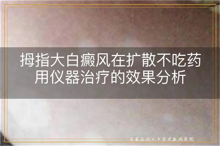 拇指大白癜风在扩散不吃药用仪器治疗的效果分析