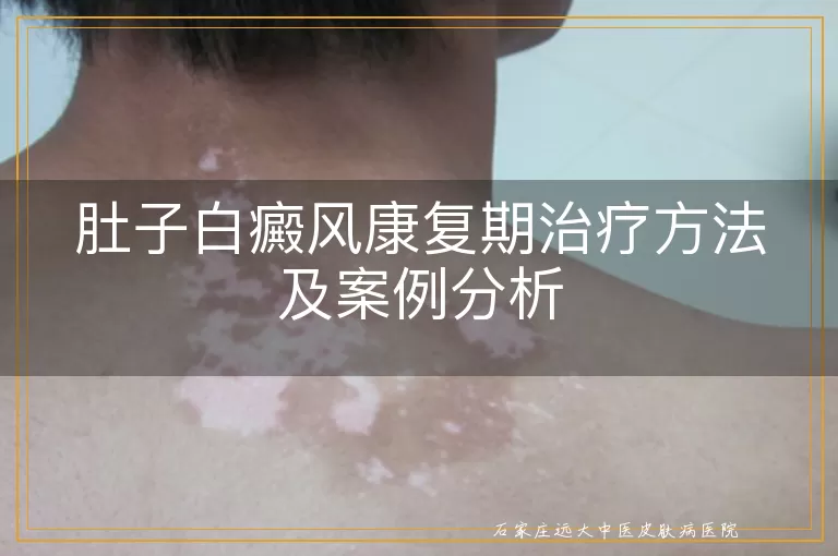 肚子白癜风康复期治疗方法及案例分析
