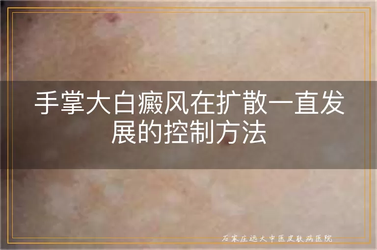 手掌大白癜风在扩散一直发展的控制方法