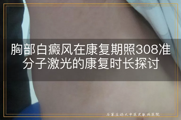 胸部白癜风在康复期照308准分子激光的康复时长探讨