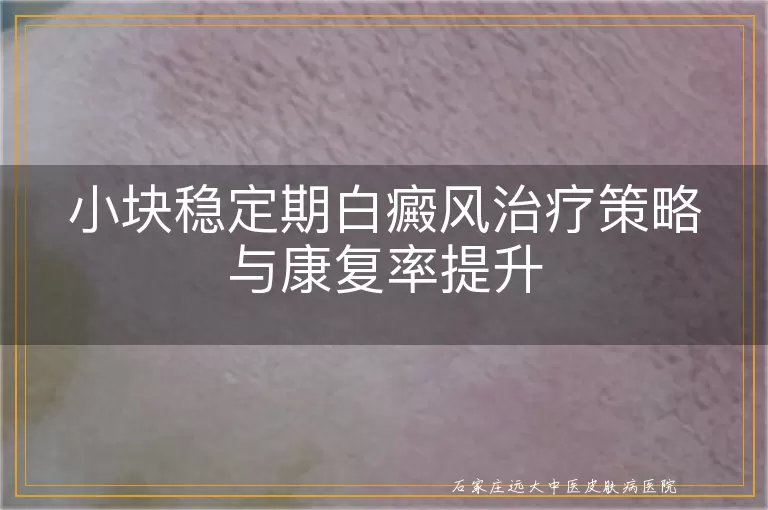 小块稳定期白癜风治疗策略与康复率提升