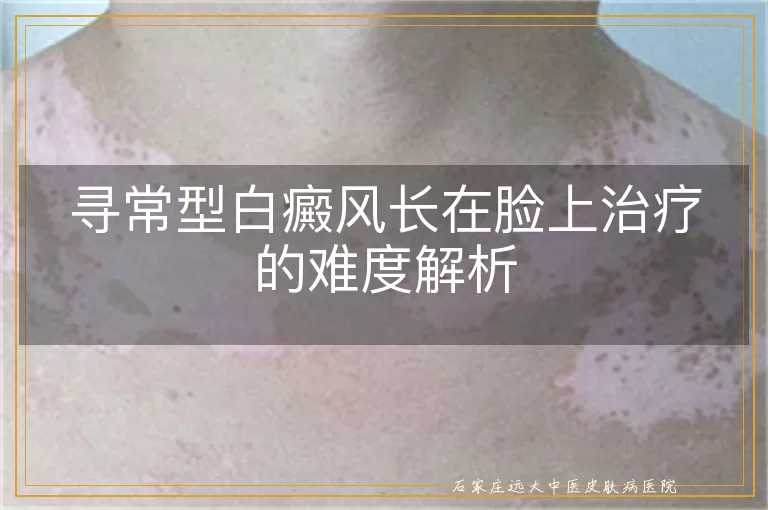 寻常型白癜风长在脸上治疗的难度解析