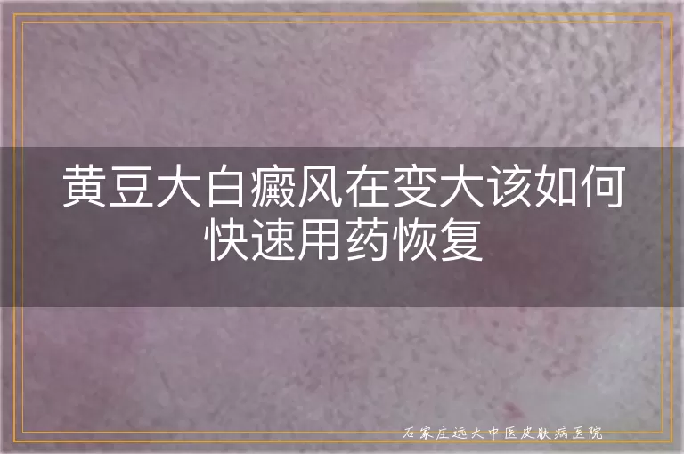 黄豆大白癜风在变大该如何快速用药恢复
