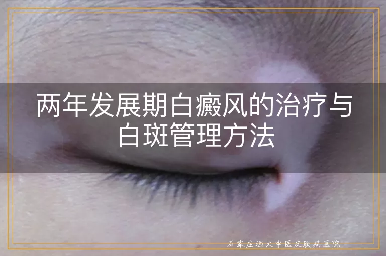 两年发展期白癜风的治疗与白斑管理方法