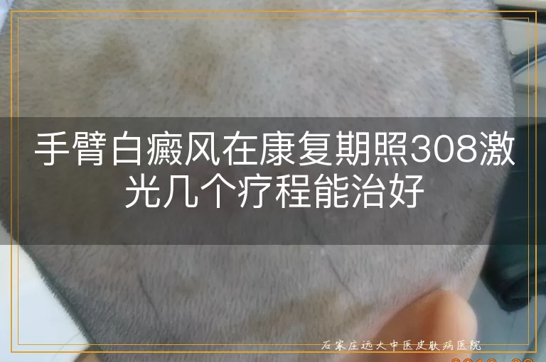 手臂白癜风在康复期照308激光几个疗程能治好