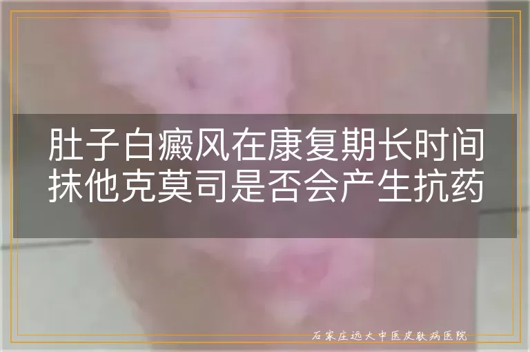 肚子白癜风在康复期长时间抹他克莫司是否会产生抗药性