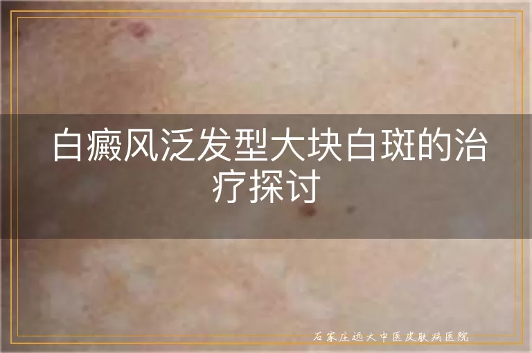 白癜风泛发型大块白斑的治疗探讨