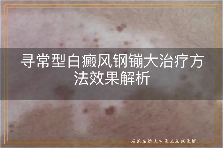 寻常型白癜风钢镚大治疗方法效果解析