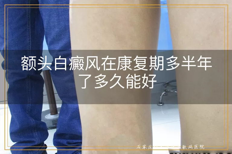 额头白癜风在康复期多半年了多久能好