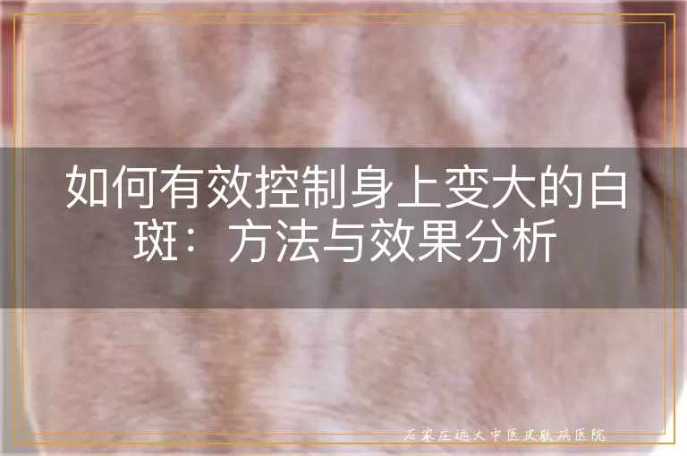 如何有效控制身上变大的白斑:方法与效果分析