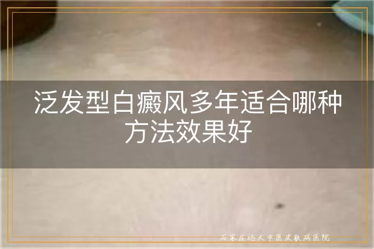 泛发型白癜风多年适合哪种方法效果好