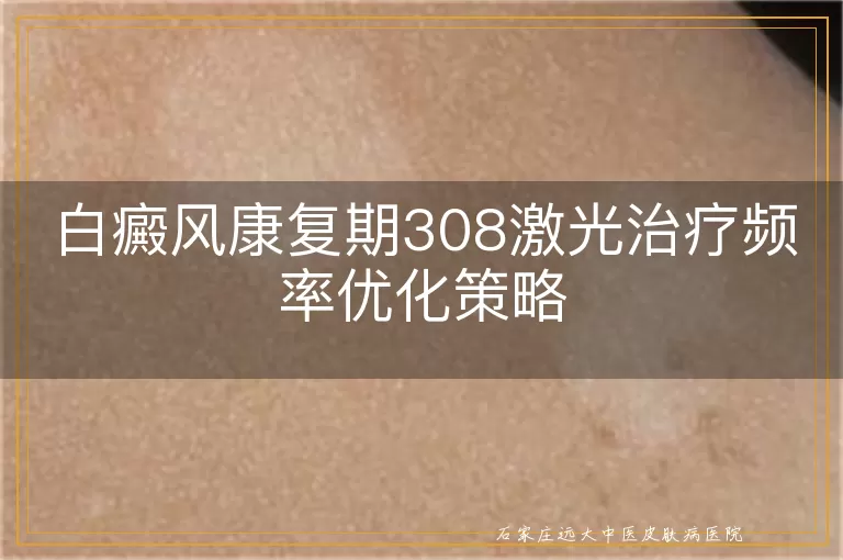 白癜风康复期308激光治疗频率优化策略