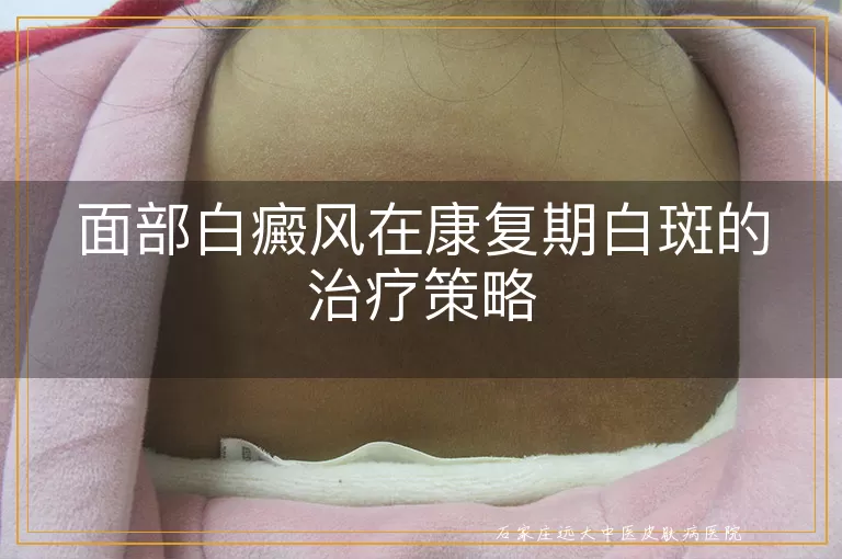 面部白癜风在康复期白斑的治疗策略